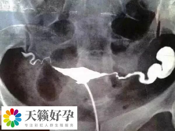 輸卵管積水含微生物碎屑等有害物質多