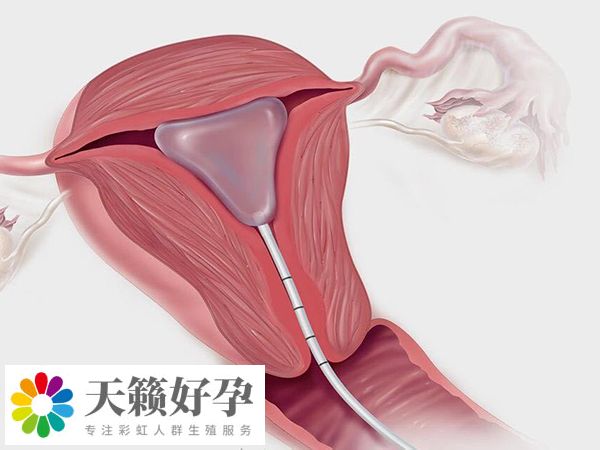 宮內探查能發現宮腔粘連