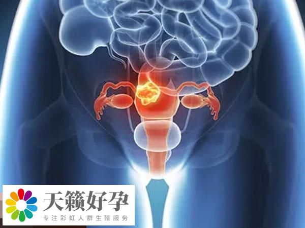 不當使用賀美奇會導致卵巢過度刺激