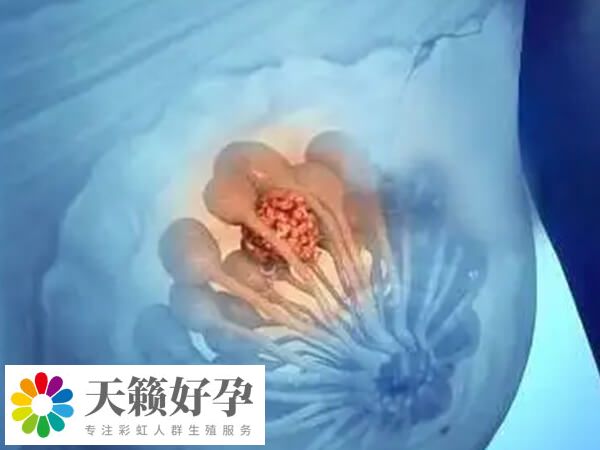 乳腺纖維瘤做試管會(huì)不會(huì)影響加重